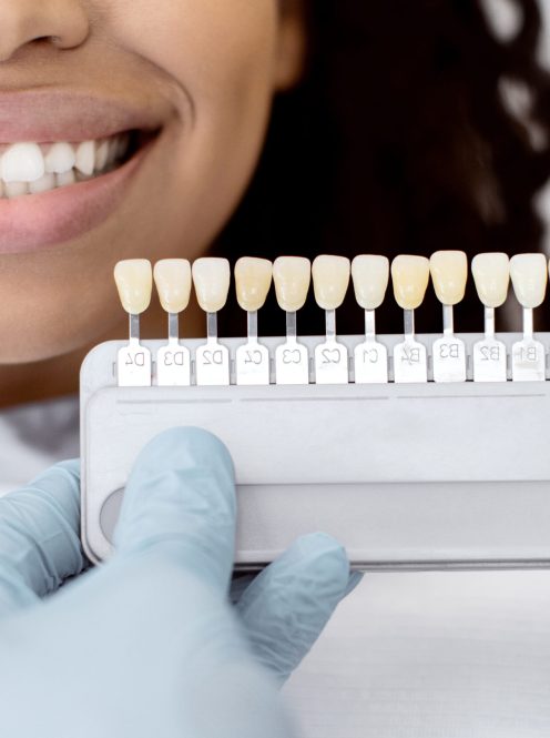 professional teeth Whitening
